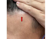 治療禿頭  美顏針棒