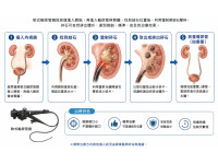 軟式輸尿管鏡碎石的新認識